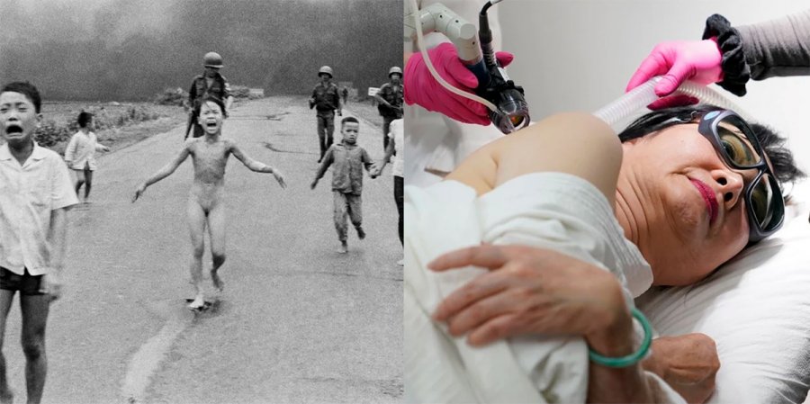 To «κορίτσι της Ναπάλμ» υποβλήθηκε στην τελική θεραπεία -Μισό αιώνα μετά τη συγκλονιστικότερη φωτογραφία του πολέμου του Βιετνάμ